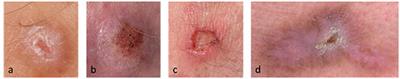 Chronic Prurigo: Similar Clinical Profile and Burden Across Clinical Phenotypes